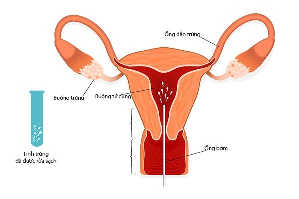 Bơm tinh trùng vào tử cung