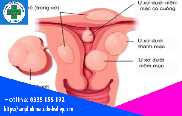 cac-loai-nhan-xo-tu-cung-2 Các loại nhân xơ tử cung