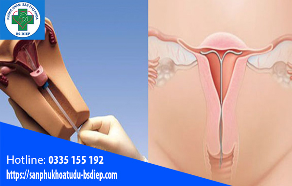 Đặt vòng tránh thai