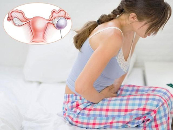 Dấu hiệu buồng trứng đa nang