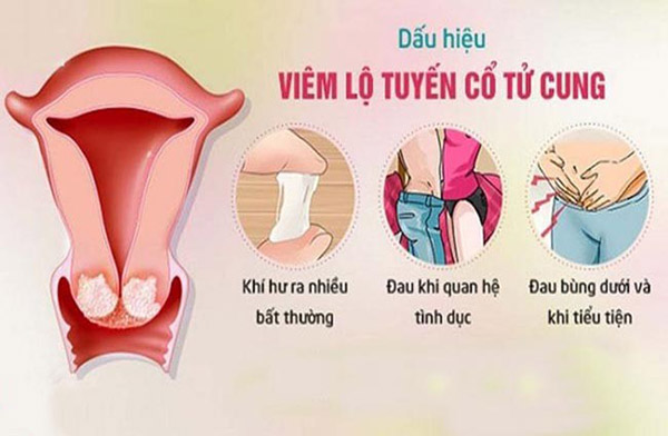 dau-hieu-viem-lo-tuyen-co-tu-cung-1 Viêm lộ tuyến cổ tử cung