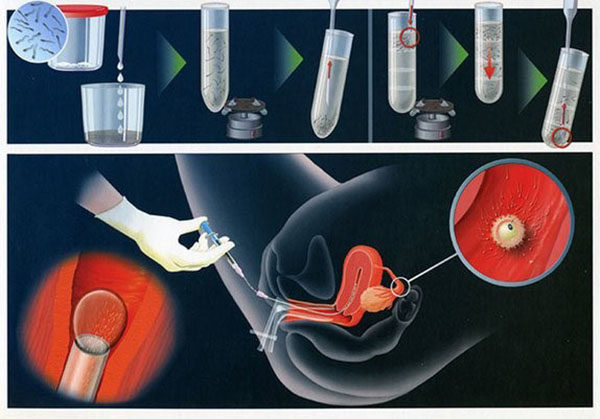 Điều kiện thực hiện Phương pháp bơm tinh trùng vào tử cung