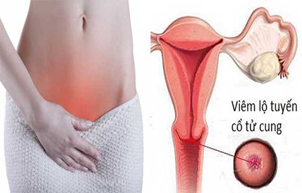 dieu-tri-viem-lo-tuyen-co-tu-cung Điều trị viêm lộ tuyến cổ tử cung