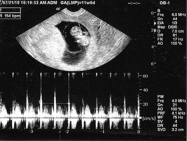 Hình ảnh thai nhi 8 tuần