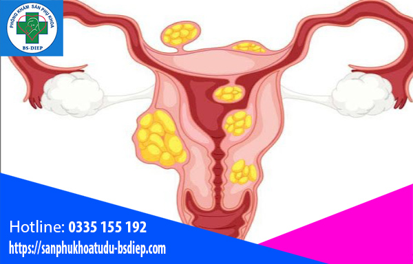 kich-thuoc-nhan-xo-tu-cung-01 Lích thước nhân xơ tử cung