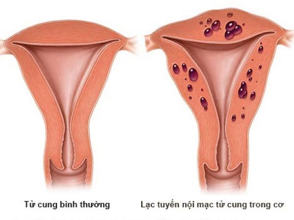 lac-noi-mac-trong-co-tu-cung Lạc nội mạc trong cơ tử cung