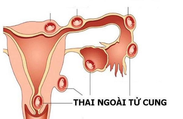 Mangthai ngoài tử cung