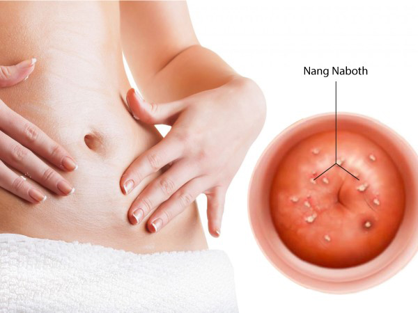 Nang naboth cổ tử cung