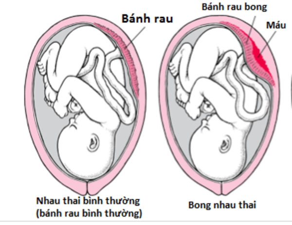 Nhau bong non