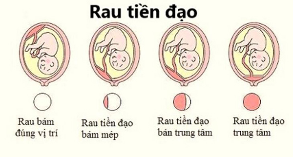 Nhau tiền đạo có nguy hiểm không là điều mà thai phụ lo lắng