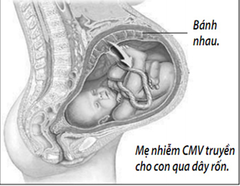 Nhiễm trùng bào thai
