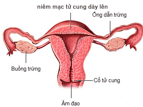 Niêm mạc tử cung dày