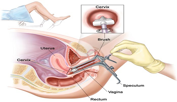 Tác dụng của soi cổ tử cung khi khám phụ khoa