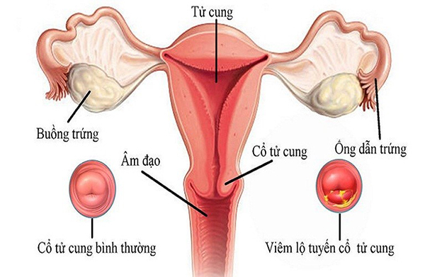 Quan hệ ngày kinh dễ mắc bênh phụ nữ