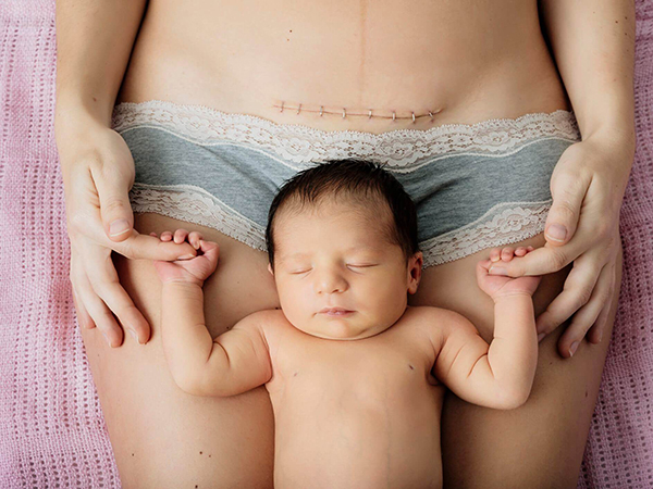 Vết sẹo sinh mổ cũng là nguyên nhân gây ra tình trạng đến tháng ra máu đen