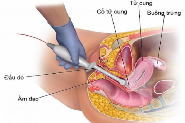 sieu-am-dau-do Siêu âm đầu dò