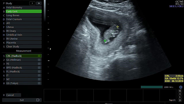 Bạn đang có thai và muốn biết thêm về thai nhi của mình? Siêu âm thai đơn 10 tuần là một trong những bước đầu tiên để xác định sức khỏe của em bé. Hãy xem hình ảnh để rõ hơn về những bước đầu của chuyến hành trình đầy kỳ vọng này.