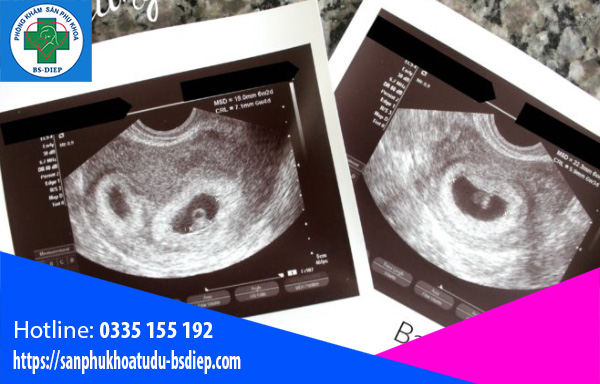 Siêu âm thai 6 tuần là lúc thai nhi bắt đầu có những nhịp đập của tim. Hình ảnh siêu âm sẽ giúp bạn xem được một khối u nhỏ mang tính biểu tượng của thai nhi và tìm hiểu thêm về quá trình thai kỳ. Hãy xem hình ảnh siêu âm thai 6 tuần để khám phá thêm về cuộc hành trình đầy kỳ diệu này.