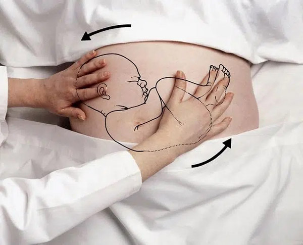 Bác sĩ có thể tác động từ bên ngoài để xoay chuyển hướng nằm của bé.