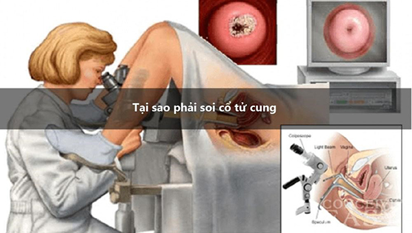 tai-sao-phai-noi-soi-co-tu-cung