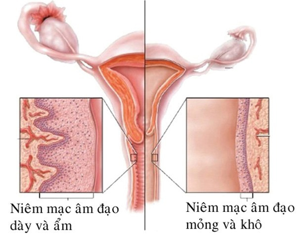 teo-am-dao-1 Teo âm đạo