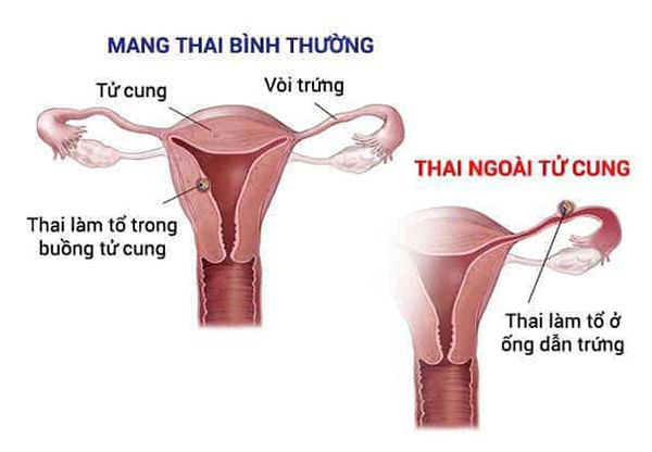 thai-chua-vao-tu-cung Tại sao thử thai 2 vạch như thai chưa vào tử cung?