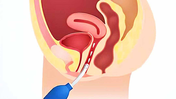 Thụt rửa âm đạp là cách làm sạch sâu âm đạo của phụ nữ