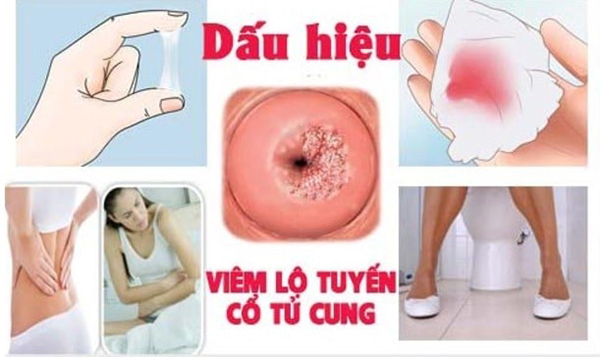 trieu-chung-viem-lo-tuyen-co-tu-cung Triệu chứng viêm lộ tuyến cổ tử cung