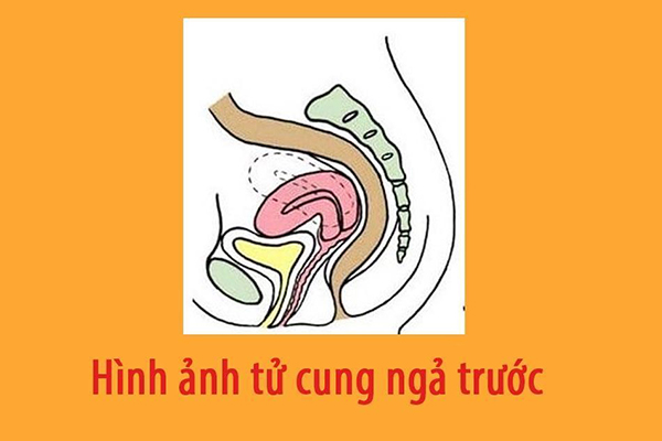 Tình trạng tử cung ngả trước và những vấn đề liên quan