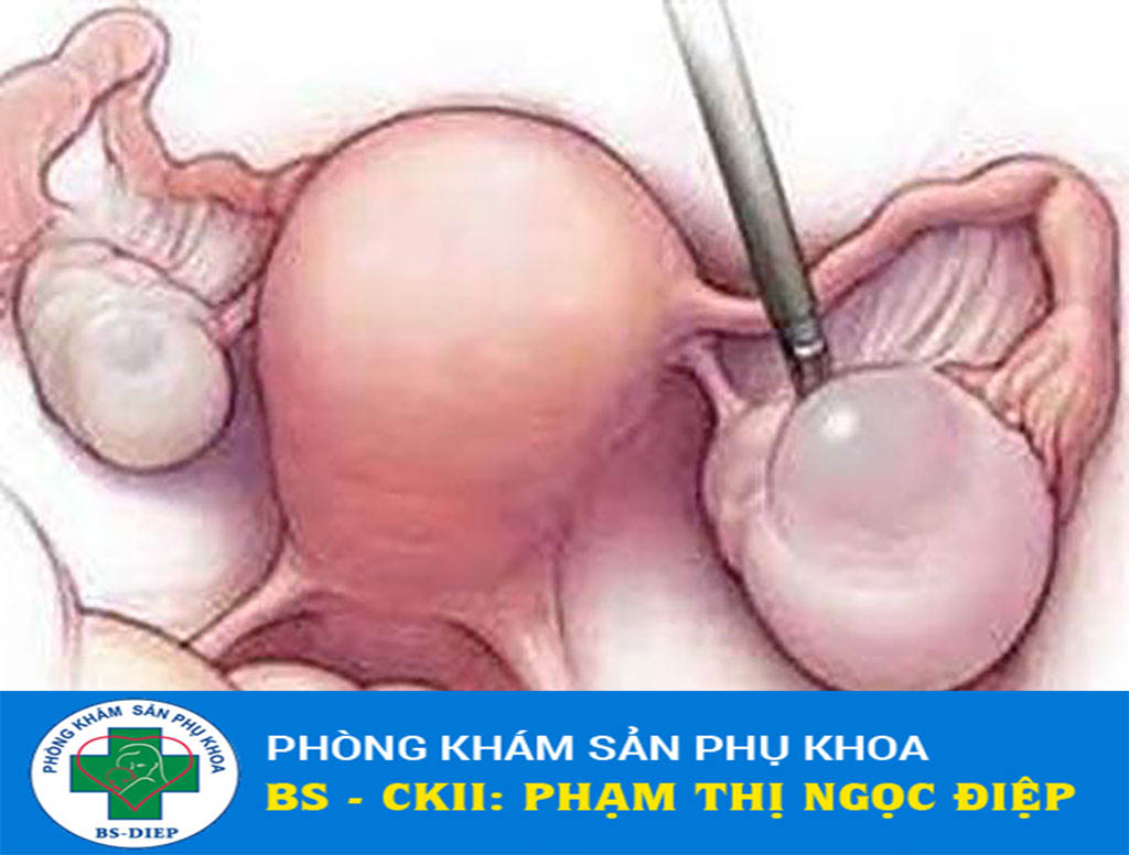 u-nang-buong-trung-co-nguy-hiem-khong-1 U nang buồng trứng