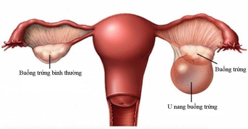 U nang buồng trứng phải có thai được không