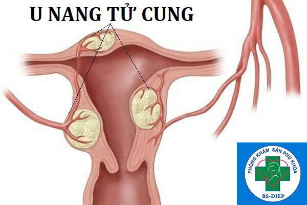 Dấu hiệu u nang tử cung và cách nhận biết chính xác nhất