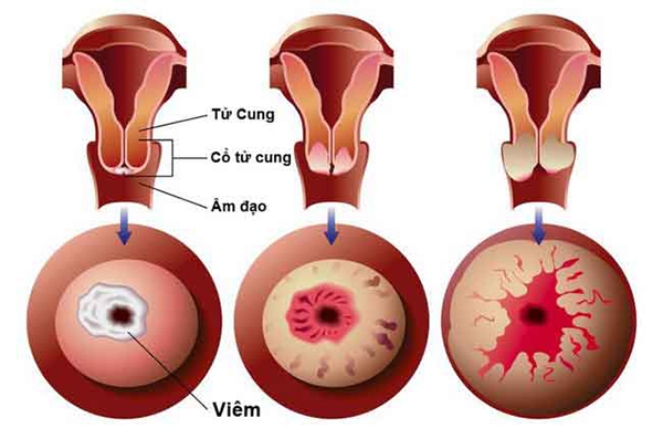 viem-lo-tuyen-co-tu-cung-01 hình ảnh viêm lộ tuyến cổ tử cung
