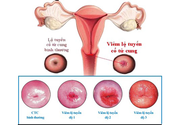 viem-lo-tuyen-co-tu-cung1-1 Viêm lộ tuyến cổ tử cung
