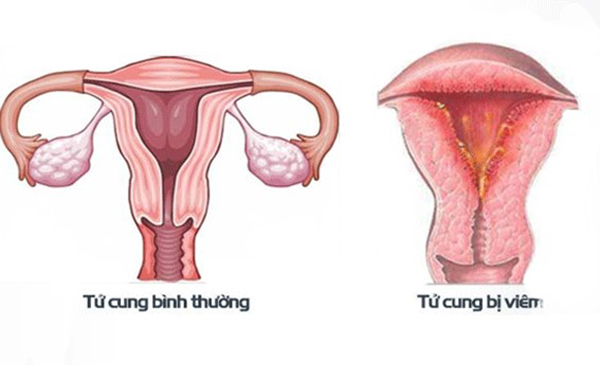 viem-noi-mac-tu-cung Viêm nội mạc tử cung