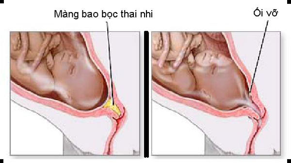 vo-oi-trong-thai-ky Vỡ ối